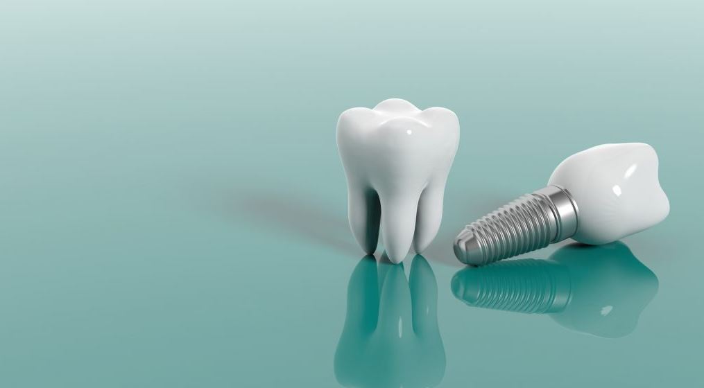 dental implants