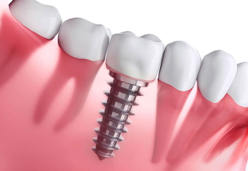 cosmetic dental implants